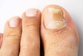6 home remes for toenail fungus
