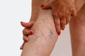 varicose vein treatment south sydney