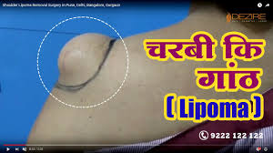 nonsurgical lipoma removal what is