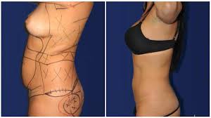 el paso liposuction specialty clinic