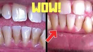 How to brush your teeth with braces. How To Get Rid Of Tartar On Teeth Reddit Teethwalls