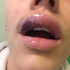got 1ml juvaderm lip fillers 2 days ago