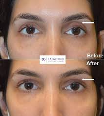 eyelid filler injection before and