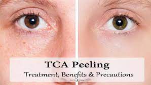 tca ling treatment details