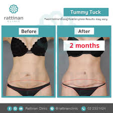 how to find the best tummy tuck in thailand