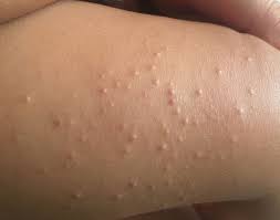 viral infections children skin