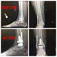 total ankle replacement