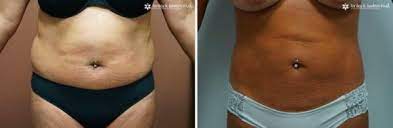 how much does a mini tummy tuck cost