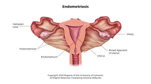 Endometriosis is a condition where the tissue that's typically found on the inside of your uterus grows on the outside of it. Endometriosis In Girls Children S Hospital Colorado