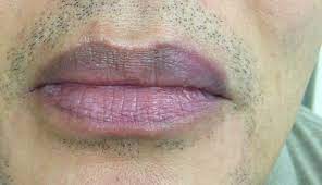 derm dx painful lip swelling crusting