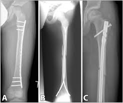 pediatric diaphyseal femur fractures