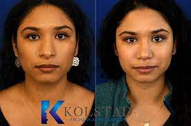 Check spelling or type a new query. Wide Nose Rhinoplasty Results Dr Kolstad San Diego Facial Plastic Surgeon