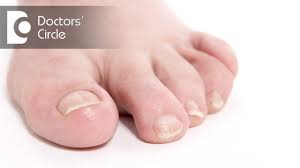 causes of brittle toenails and its