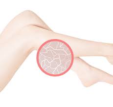 Trockene Schuppige Haut An Den Beinen Hautpflege Bei Kompressionsstrumpfen