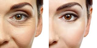 treat eyelid wrinkles