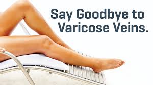 Insurance companies will cover treatments for varicose veins if you have symptoms. Varicose Veins