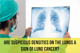 Maybe you would like to learn more about one of these? Suspicious Densities On The Lungs A Sign Of Lung Cancer Respiratory Tract Disorders And Diseases Articles Body Health Conditions Center Steadyhealth Com