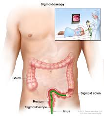 Colon and rectal cancers (call. Colon Cancer Treatment Pdq Patient Version National Cancer Institute