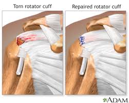 rotator cuff repair series aftercare