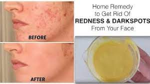 red spots from your face mamtha nair