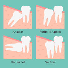 wisdom tooth extractions tewantin