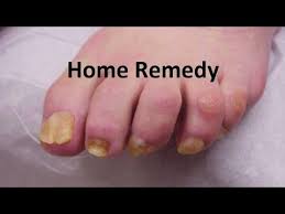 listerine toenail fungus home remedy
