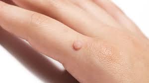 warts what are they treatment