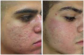 acne scar treatment dallas