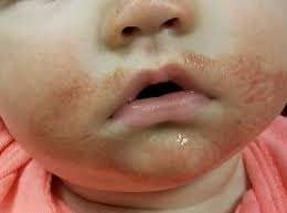 baby s rash causes family feud
