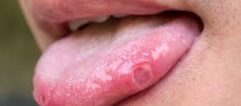 what are common tongue diseases