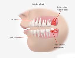 get relief from wisdom teeth pain