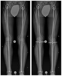 leg length discrepancy after skeletal