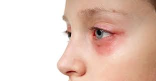allergic shiners causes and treatments
