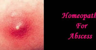 abscess treatment in homeopathy guide