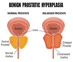 Prostate Problems Complications And Treatments gambar png