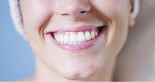 اسباب بروز الاسنان الأمامية وطرق العلاج بالتلبيس