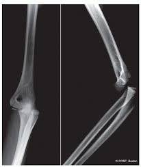 Featuring rami alrabaa, george popa. Medial Epicondyle Fractures And Elbow Dislocations Musculoskeletal Key