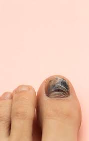 black toenails foot ankle