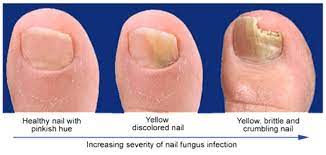 causes and treatments of toenail fungus