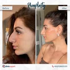 rhinoplasty surgery change your face