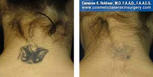 laser tattoo removal in nyc and long island