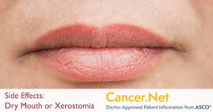 dry mouth or xerostomia cancer net