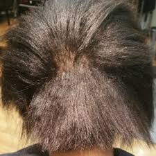hair loss and hair breakage