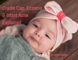 cradle cap eczema and infant acne
