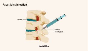 your guide to facet joint injections