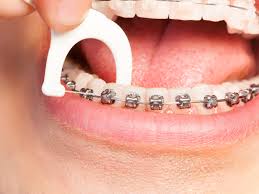 how often should braces be cleaned
