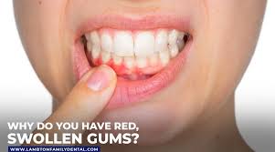 why do you have red swollen gums