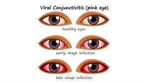conjunctivitis causes how it spreads
