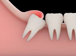 wisdom teeth anacapa surgery