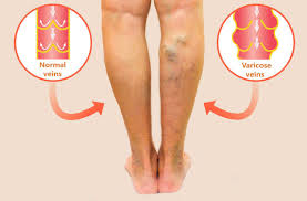 varicose veins treatment and surgical